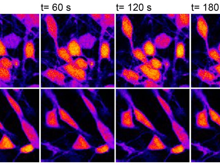 Alzheimer familiar: crean neuronas humanas para explorar los mecanismos de la neurodegeneración