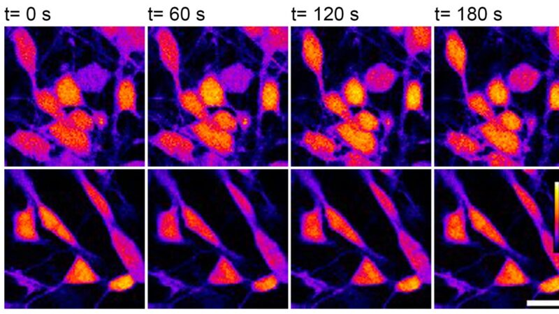 Alzheimer familiar: crean neuronas humanas para explorar los mecanismos de la neurodegeneración