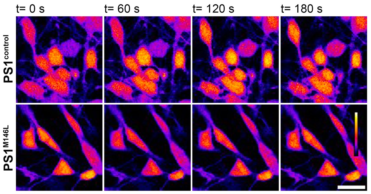 Alzheimer familiar: crean neuronas humanas para explorar los mecanismos de la neurodegeneración