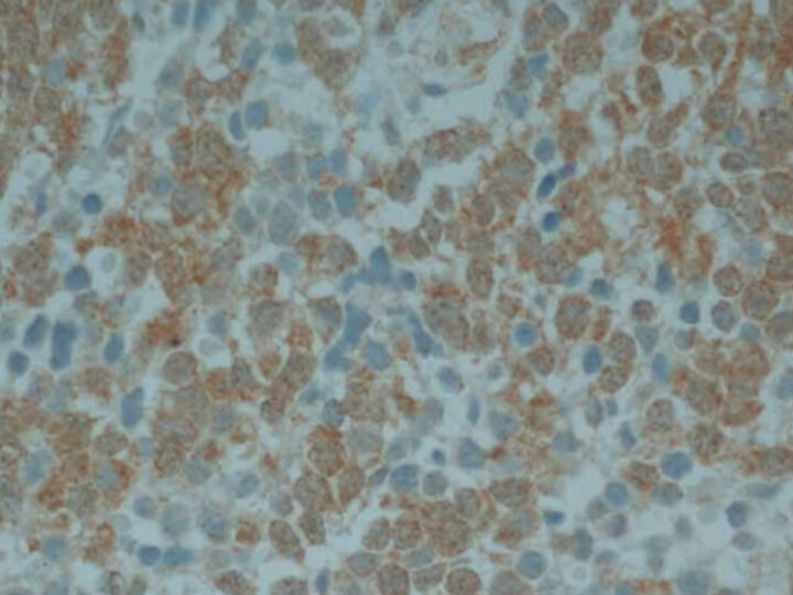 Avances en terapia contra un tumor pediátrico agresivo