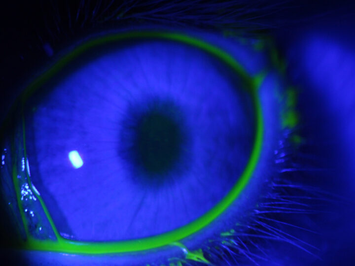 Científicos trabajan en la optimización del tratamiento contra el glaucoma