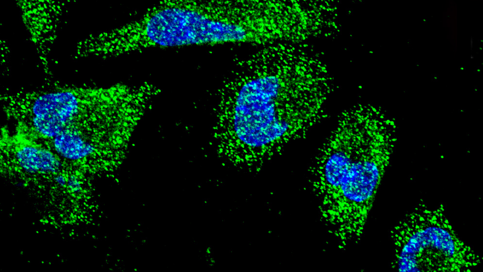 Descubren cómo se comunican las células del cáncer pancreático para sobrevivir a condiciones adversas